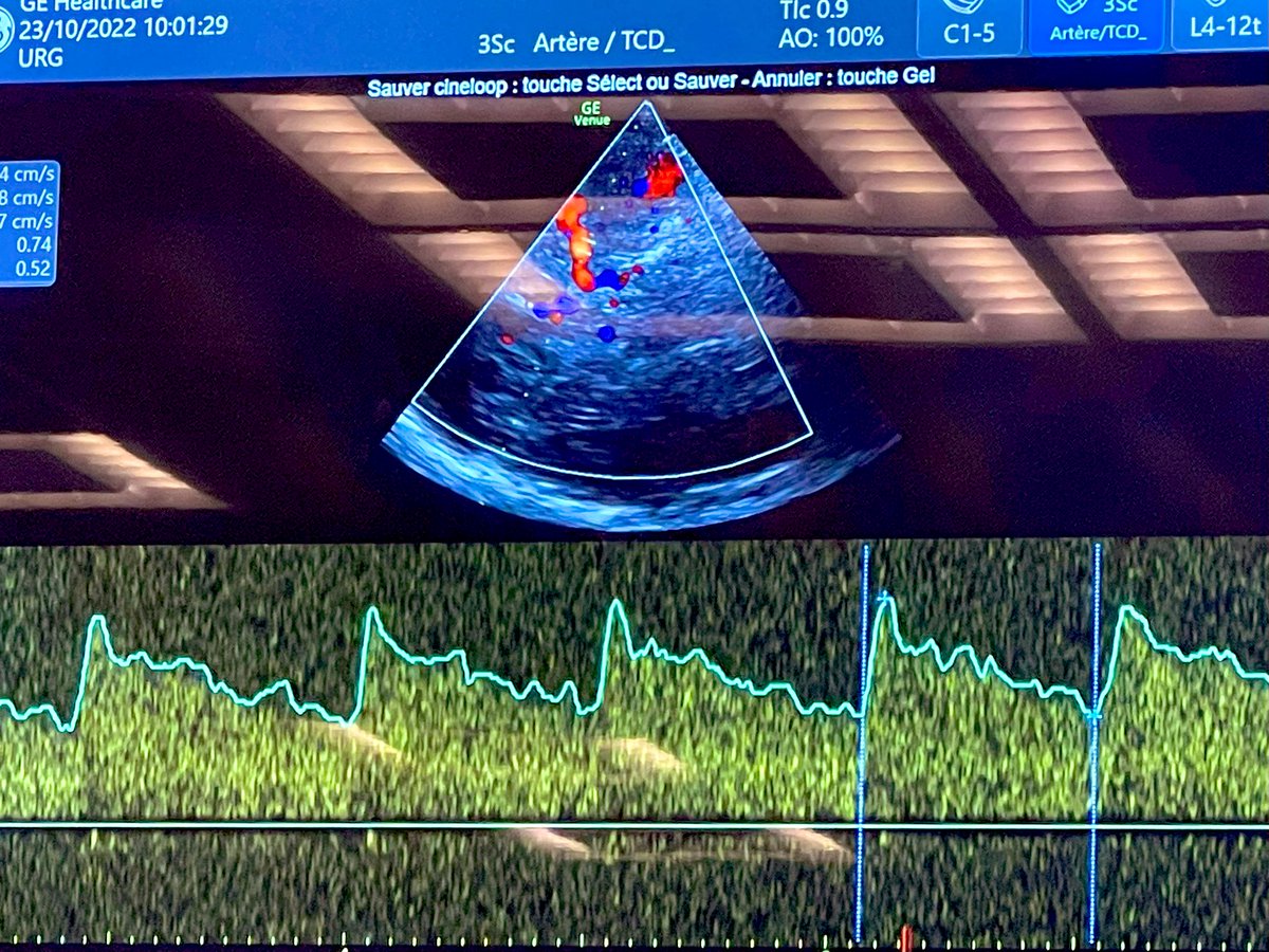 FOAMecmo's tweet photo. 🦋 Brain #ultrasound? NOT only in neurocritically ill but also in general #ICU ie after cardiac arrest or #sepsis
4 windows
🪟 temporal (major)
🪟 submandibular (carotid)
🪟 optical (linear probe for OSND)
🪟 suboccipital (vertebral/basilar)
#LIVES2022
@chiara_robba @aartisarwal https://t.co/XUz4u0ZOCC