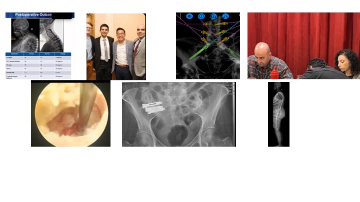Muhammad Abd-El-Barr MD PhD FAANS (@abdelbarrspine) on Twitter photo <a href="/DukeSpine/">Duke Spine</a> Fellowship is an integrated Neurosurgery/Orthopedic fellowship designed to introduce fellows to the breath and depth of all aspects of Spine Surgery. For more information or to apply please email: m.abdelbarr@duke.edu. <a href="/Dukeneurosurg/">Duke Neurosurgery</a> <a href="/DukeOrtho/">Duke Orthopaedics</a> <a href="/DukeSpine/">Duke Spine</a> Fellowship is an integrated Neurosurgery/Orthopedic fellowship designed to introduce fellows to the breath and depth of all aspects of Spine Surgery. For more information or to apply please email: m.abdelbarr@duke.edu. <a href="/Dukeneurosurg/">Duke Neurosurgery</a> <a href="/DukeOrtho/">Duke Orthopaedics</a>