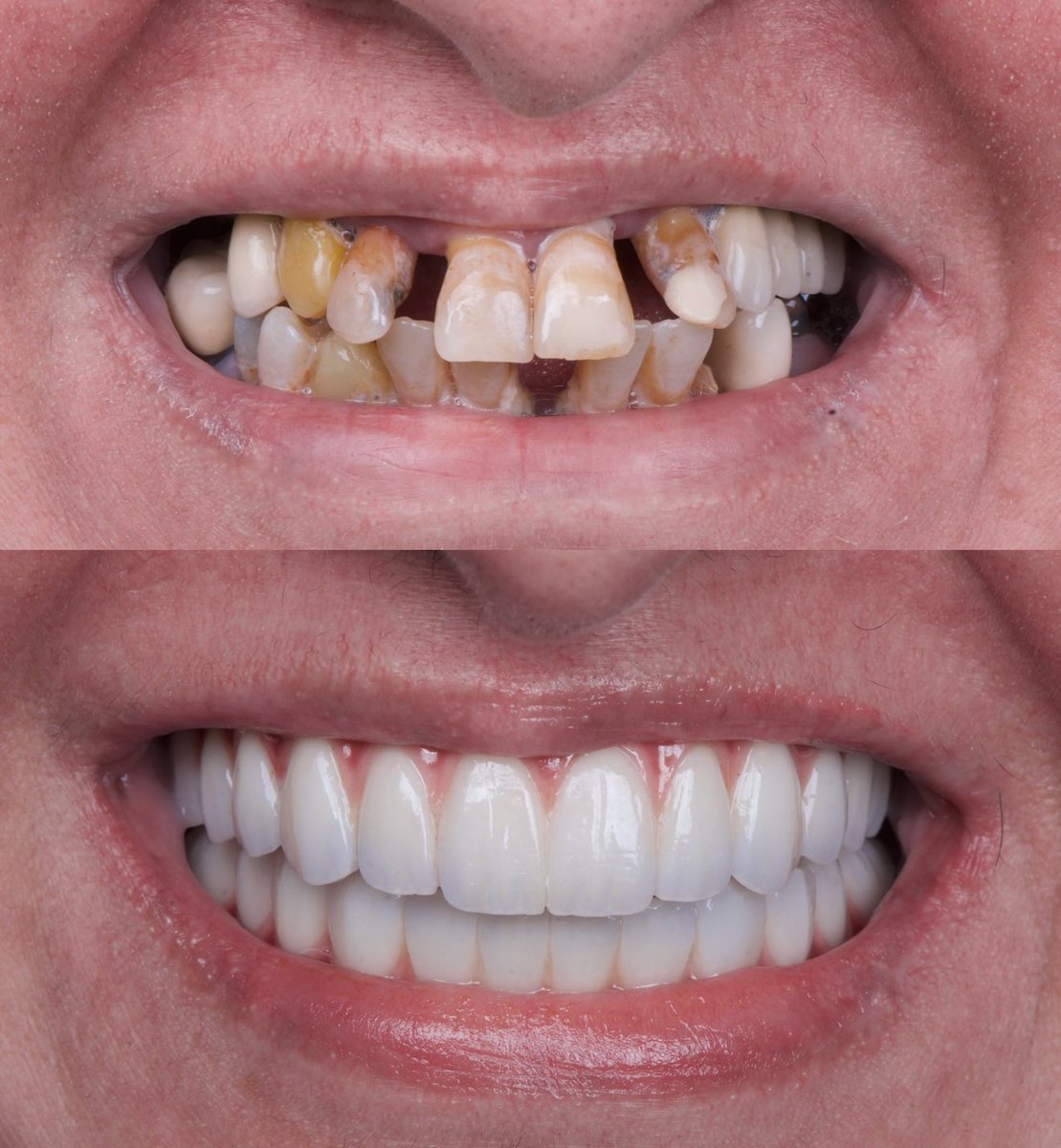 إعادة تأهيل لكامل الأسنان المتهالكة عن طريق الزرعات والتركيبات الثابته الفوائد من مثل هذا  الإجراء هو إبتسامة أجمل وظيفة أسنان افضل وبالتالي جودة حياة أعلى.
كل الشكر لاستشاري جراحة اللثة وزراعة الاسنان د عبدالكريم الحميدان على العمل المتقن <a href="/Draalhumaidan/">Dr.AAAlhumaidan</a> <a href="/dentalhousec/">Dental House Clinics</a>