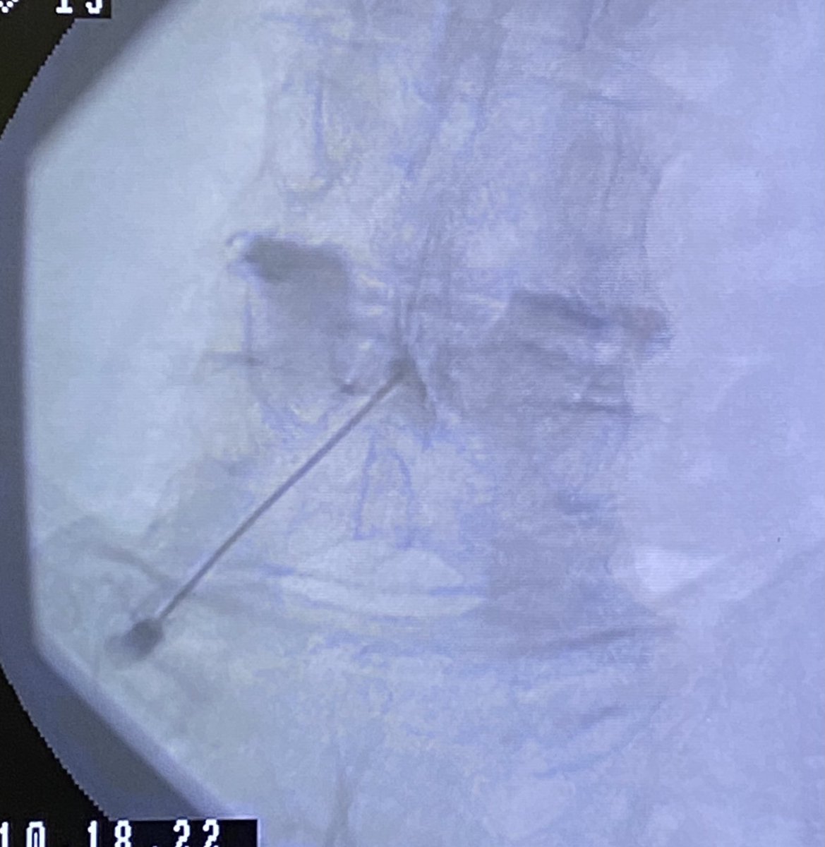 dougbeall's tweet photo. Good example of the retrodural space of Okada that connects to both facet joints accessed via an interlaminar epidural injection https://t.co/v2EehW9276