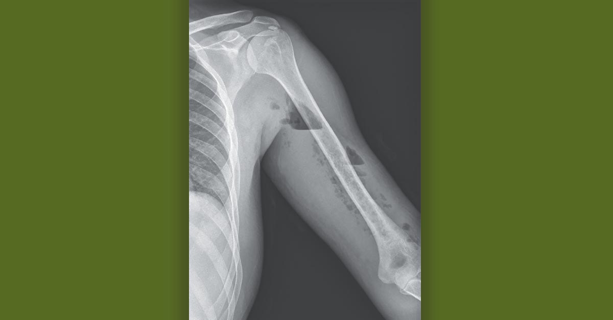 NEJM's tweet photo. A 37-year-old man presented to the emergency department with a 1-week history of pain and swelling in the left upper arm that had started after blunt trauma during soccer practice. What factor is most associated with increased mortality in this diagnosis? https://t.co/kQrNuVF5bo https://t.co/7fc0ZaE9o6