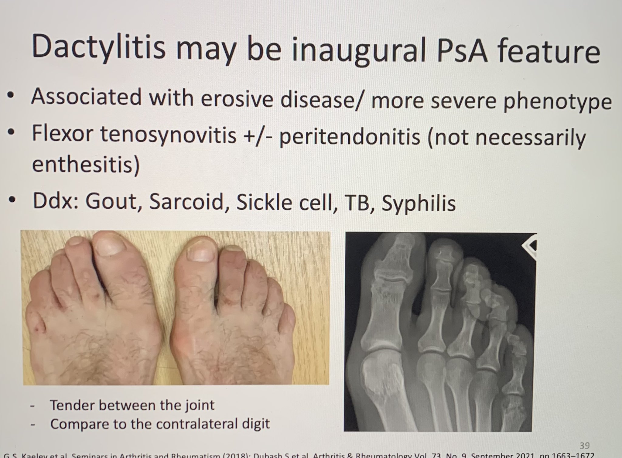 Catherine Sims, MD on Twitter "Spondyloarthritis talk by Dr. Lianne