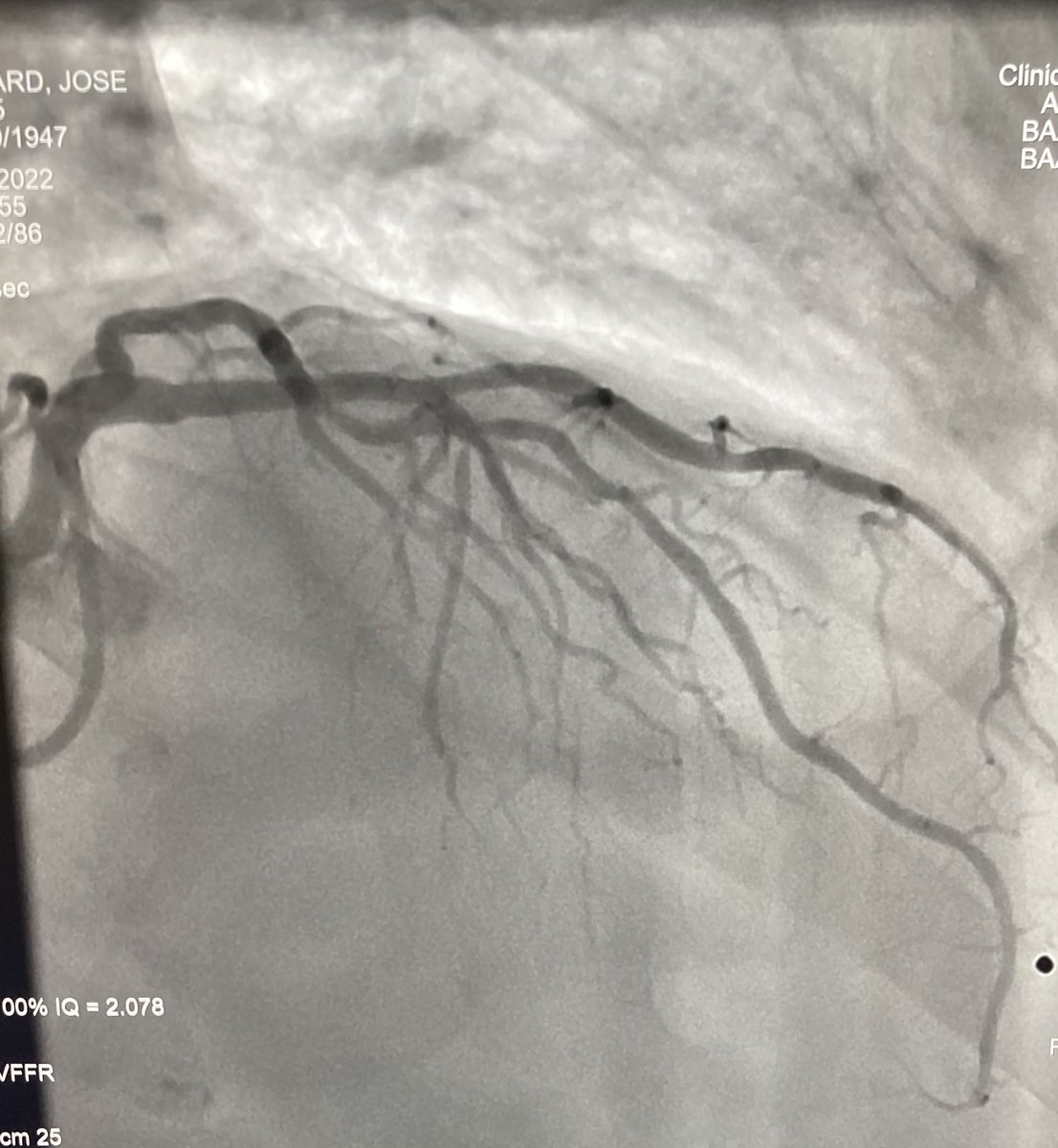 quentinlandolff's tweet photo. LAD stenosis with vFFR / FFR concordance before PCI
@SiemensHealth @SiemensHealthFR @GACIntervention @incathlab @mattgodin1 @PCRonline https://t.co/EF1xinXOlM