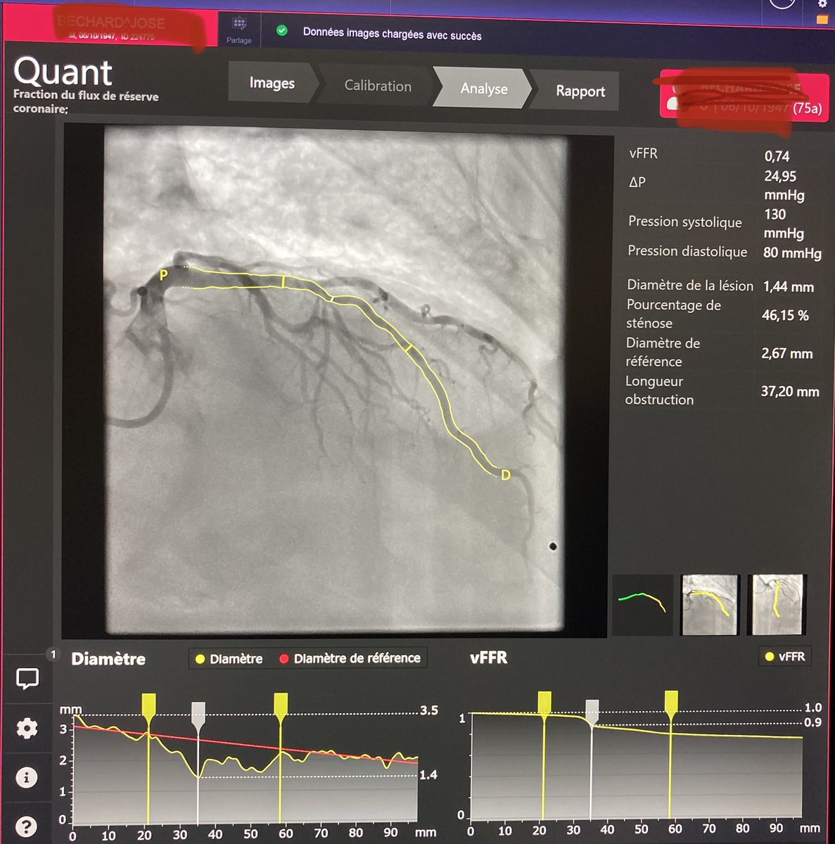 LAD stenosis with vFFR / FFR concordance before PCI @SiemensHealth @SiemensHealthFR @GACIntervention @incathlab @mattgodin1 @PCRonline