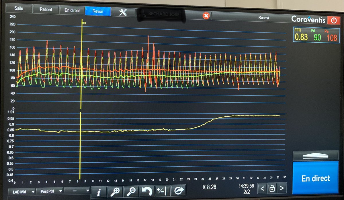 quentinlandolff's tweet photo. LAD stenosis with vFFR / FFR concordance after PCI @SiemensHealth @SiemensHealthFR  @incathlab @GACIntervention  @incathlab @mattgodin1 https://t.co/pL1Yn7NgI6