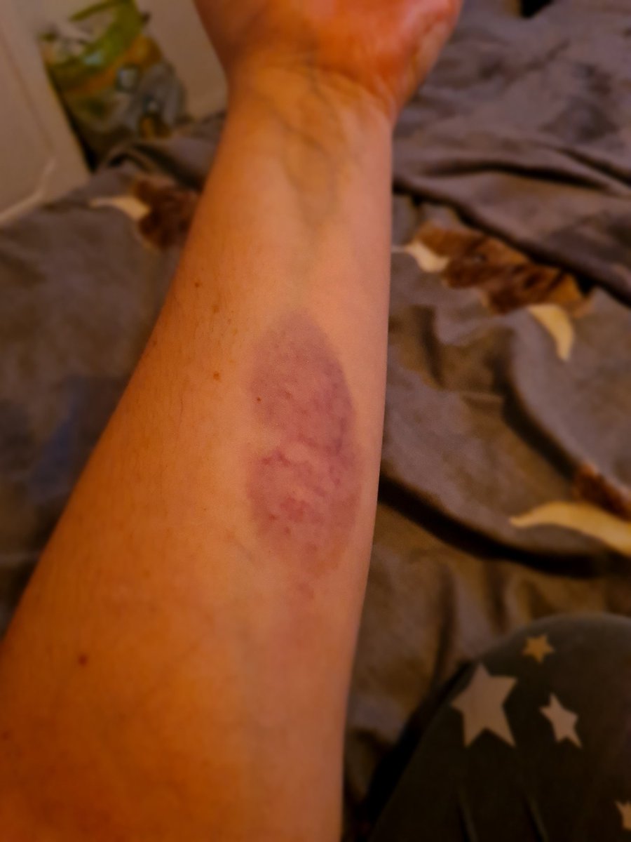 ella_mcintosh's tweet image. Amazing food this weekend at #TheRound and a whopper of a bruise left from archery 🏹