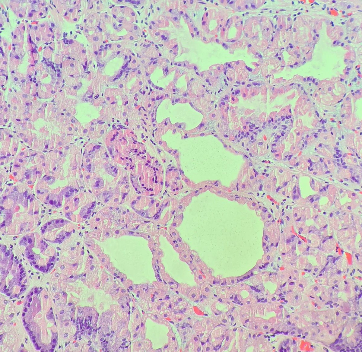 HibTheSlider's tweet image. Fundic Gland Polyp
• Hyperplastic cystically dilated glands of parietal/ oxyntic glands
• APC mutation 
• Sporadic (related to PPI use) or FAP-associated

#GIPath #TwitterPath #FundicGlandPolyp #StomachPath #PathResidents