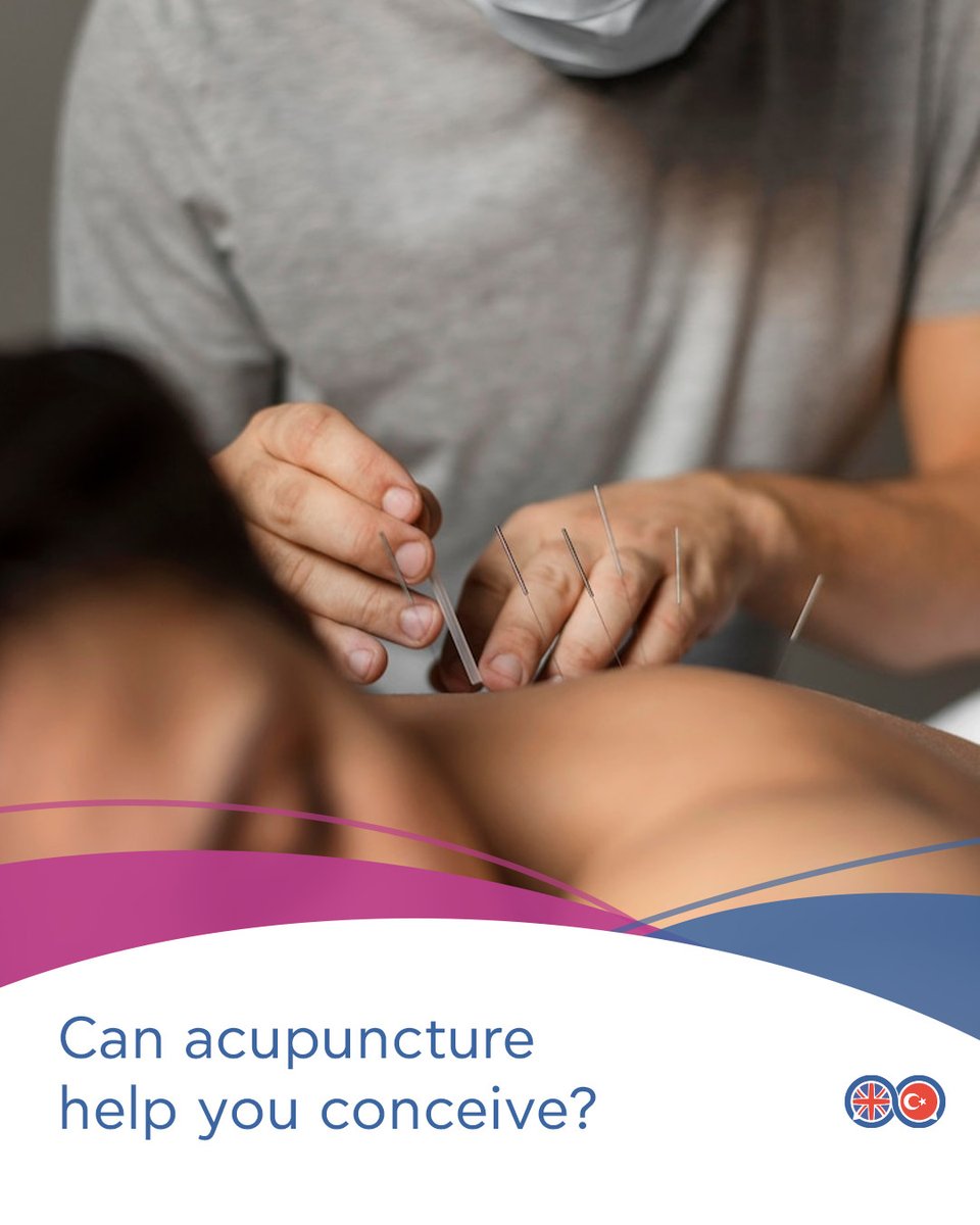 Although there is no scientific evidence that acupuncture can directly increase the success rate of IVF, acupuncture is thought to improve fertility by increasing blood flow and balancing the body's hormones. It may also help to reduce stress.

#ivfcyprus #dunyaivf #ivfcyprus