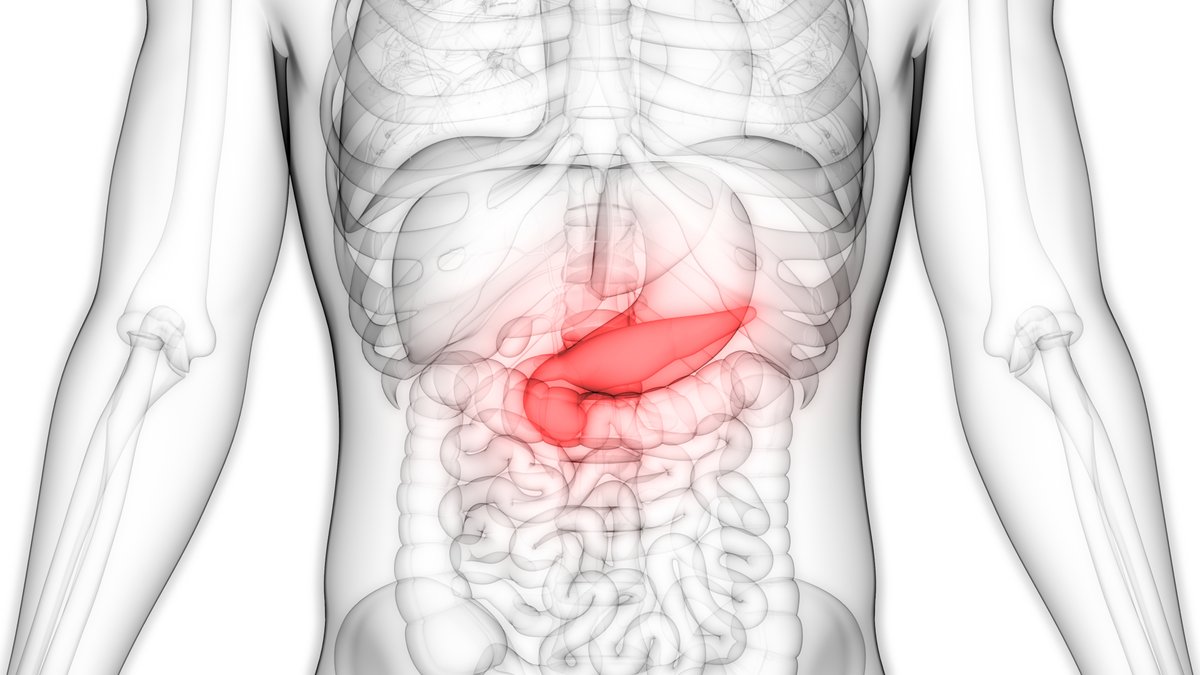 Pancreatic cancer screening of high-risk individuals leads to early-stage diagnosis, with a high incidence of resectable, early-stage disease and encouraging survival. jwat.ch/3sdSt4a @ILSONDavid #OncoTwitter