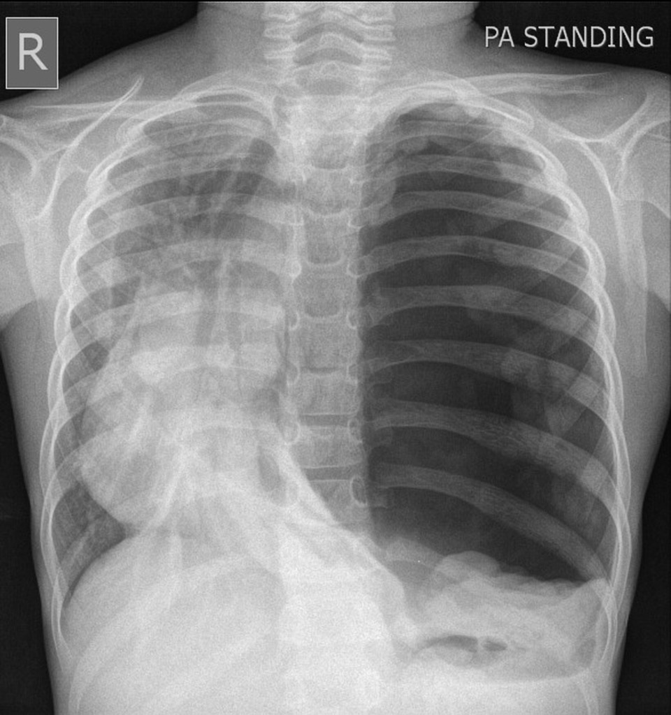 A 15 year old boy with history of chest injury presented with severe dyspnea. What is the likely diagnosis? @Radiopaedia #Medtwitter