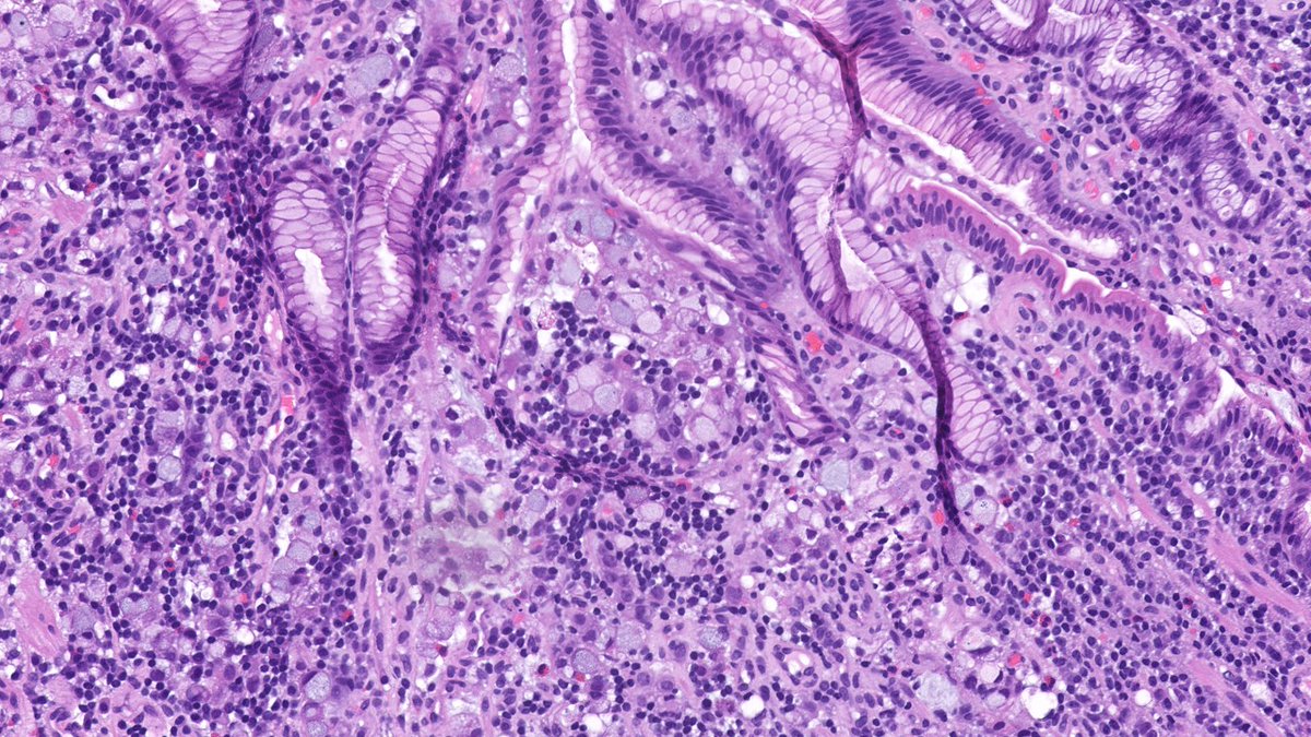 GeorgetownPath's tweet image. Gastric biopsy from a 53-year-old male. What is your diagnosis?