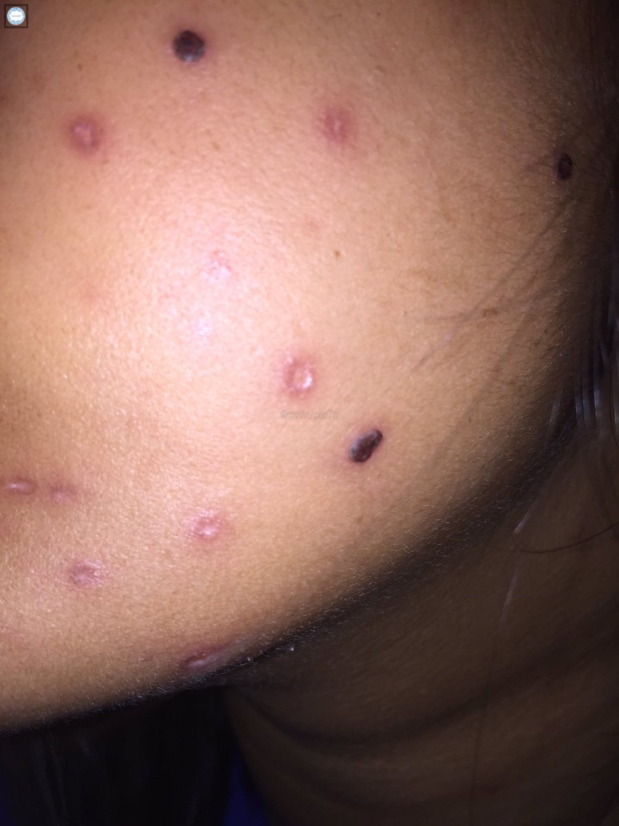 convomfs's tweet photo. 💭 menurut kalian ini bakalan hilang ga si? sender cacar di umur 19 tahun 😭😭 takut bgt liat bekasnya
ngilanginnya pake apa ya? https://t.co/teBAIlvKji