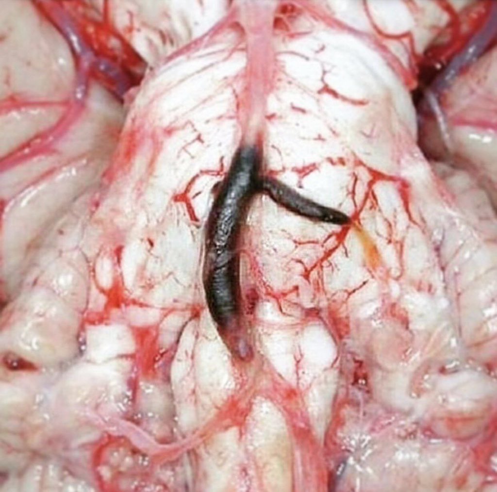 Innov_Medicine's tweet photo. When a blood clot obstructs an artery in the brain, it causes a stroke. https://t.co/KRzFKKQrlO