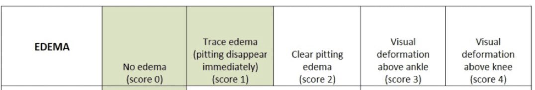 Grading edema on a 4 point scale is a great way to communicate edema because there is consensus on what it means. 🤦🏻‍♂️