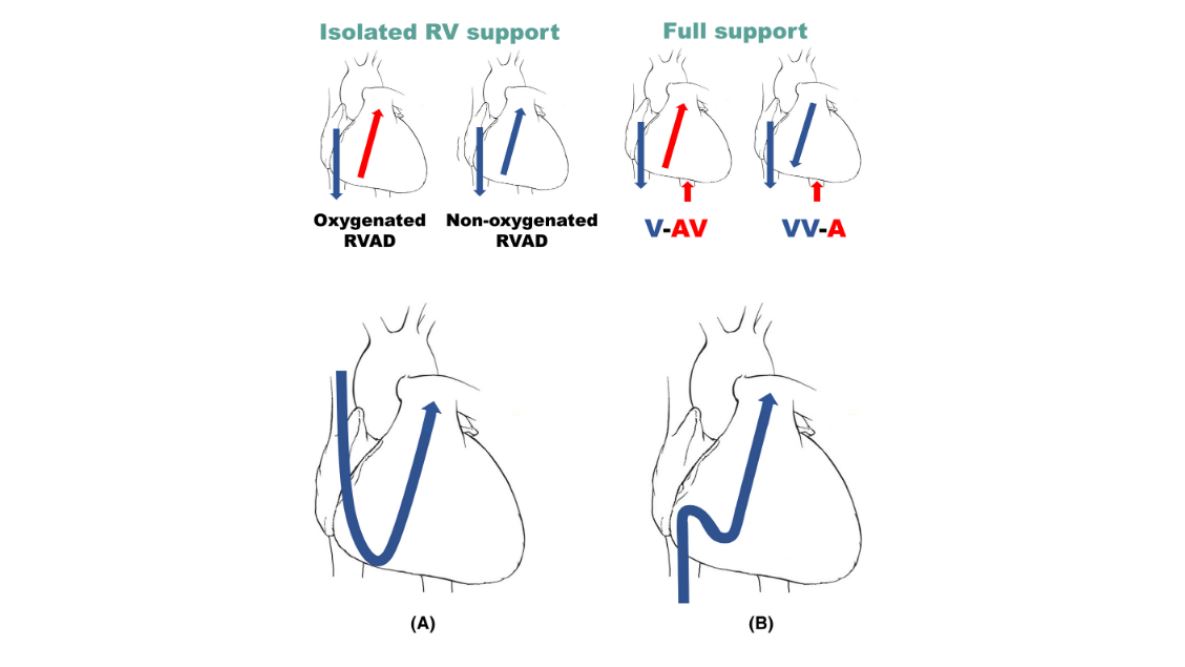 ArtifOrgans's tweet photo. Role of #Percutaneous #PulmonaryArtery cannulation in #ECLS for acute #CardiacFailure: A single-center case series👇
https://t.co/GvgXhF20fB
@NTU_Hospital🇹🇼| @APELSOorg #RightVentricularSupport https://t.co/6Mpi66I5rb
