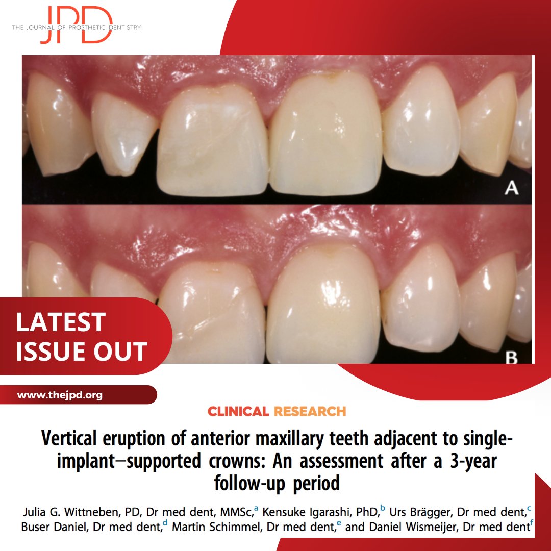 JPDentistry's tweet image. This article from the latest issue of #theJPD investigates the amount of #tootheruption that occurs with natural anterior maxillary #teeth next to a single #dentalimplant in adult patients over a 3 year period. Learn more: thejpd.org/article/S0022-…