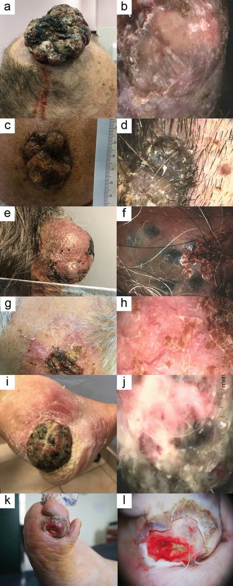 DermatolTher's tweet photo. The aim of this study was to assess #dermoscopic features of giant nodular #melanomas in special locations, along with their clinical and histopathologic aspects: https://t.co/9VqnRYszue https://t.co/m4FI6i5GWi