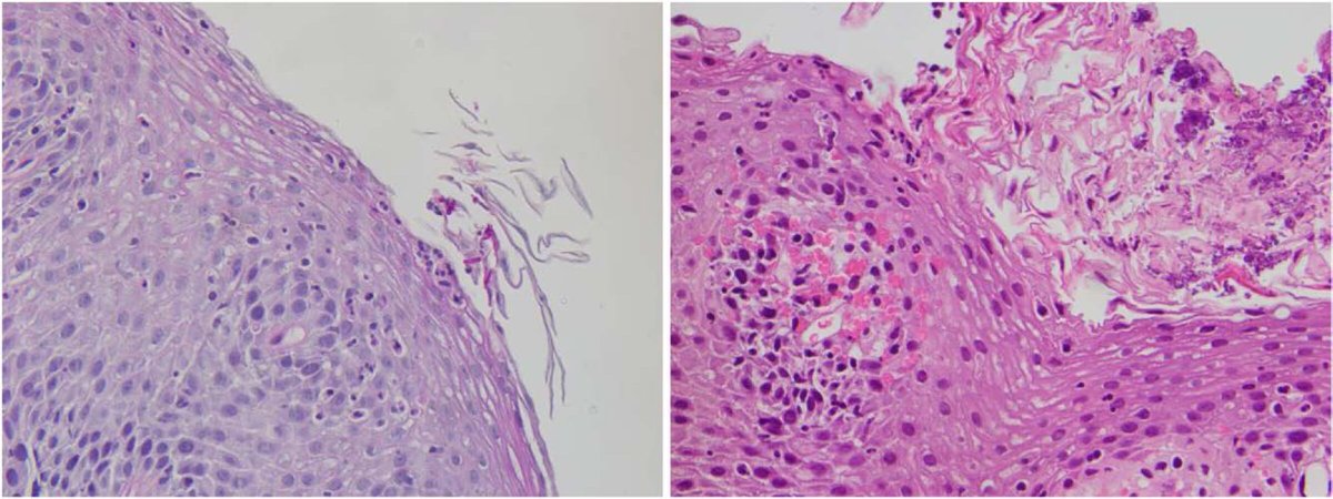 JPGN (@jpgnonline) on Twitter photo Infectious #esophagitis is the third most common cause of esophagitis after gastroesophageal reflux disease and #EoE. <a href="/jemodonnell/">Jonathan O'Donnell</a> et al. reviews risk factors, symptoms, and treatment of a wide range of organisms causing infectious esophagitis in children.
bit.ly/3FIIImI?utm_so… Infectious #esophagitis is the third most common cause of esophagitis after gastroesophageal reflux disease and #EoE. <a href="/jemodonnell/">Jonathan O'Donnell</a> et al. reviews risk factors, symptoms, and treatment of a wide range of organisms causing infectious esophagitis in children.
bit.ly/3FIIImI?utm_so…
