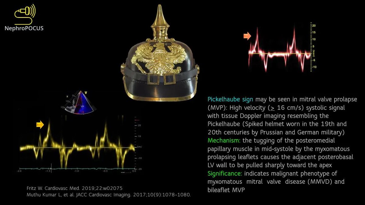 #echofirst #POCUS #MedEd #IMPOCUS 
Pickelhaube sign!