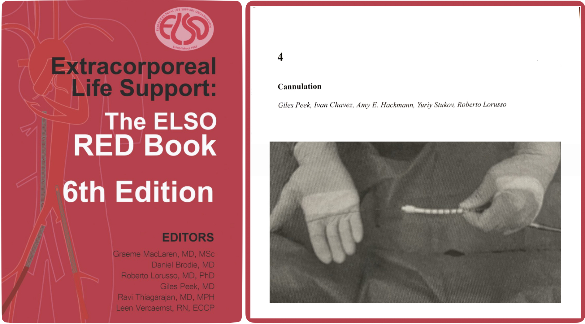 ELSO On X: ? Percutaneous & Surgical #ECMO Cannulation, 47% OFF