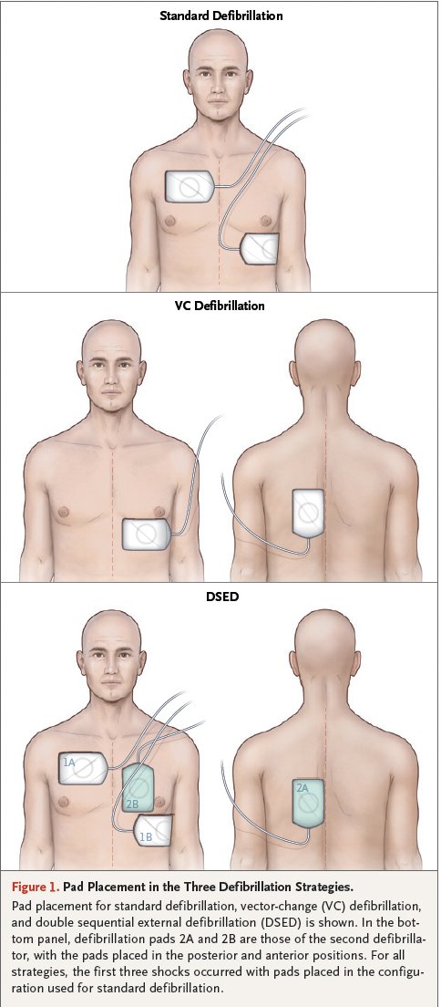 Dual sequence + vector change defib w/ improved outcomes in refractory VF bit.ly/3t5TLif Survival to 🏥d/c: 30.4% (DSED) vs 21.7% (VC) vs 13.3% (standard) DSED vs Standard RR 2.21 VC vs Standard RR 1.71 Trial stopped early but, encouraging results for DSED/VC