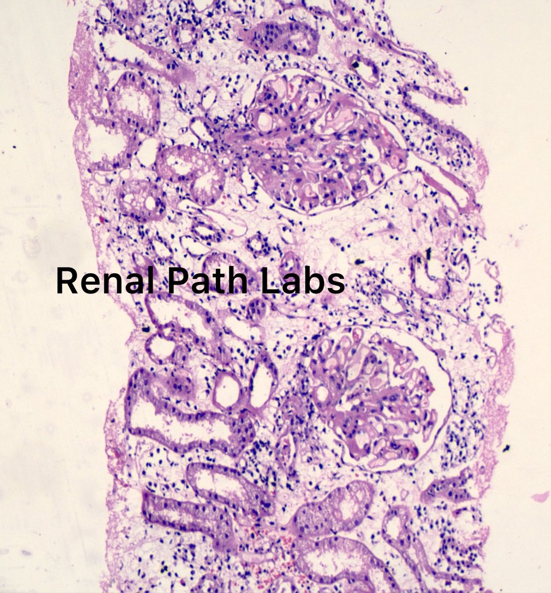 RenalPathLabs's tweet photo. For post graduates!
What do you see in these images? Different cases!
1,2: Native 3,4: Recent Transplant #RenalPath #PathTwitter #RenalPathology #Askrenal #AskrenalPath @RenalPathLabs #ISRTP #RenalPathologySociety https://t.co/E053u8iIgh