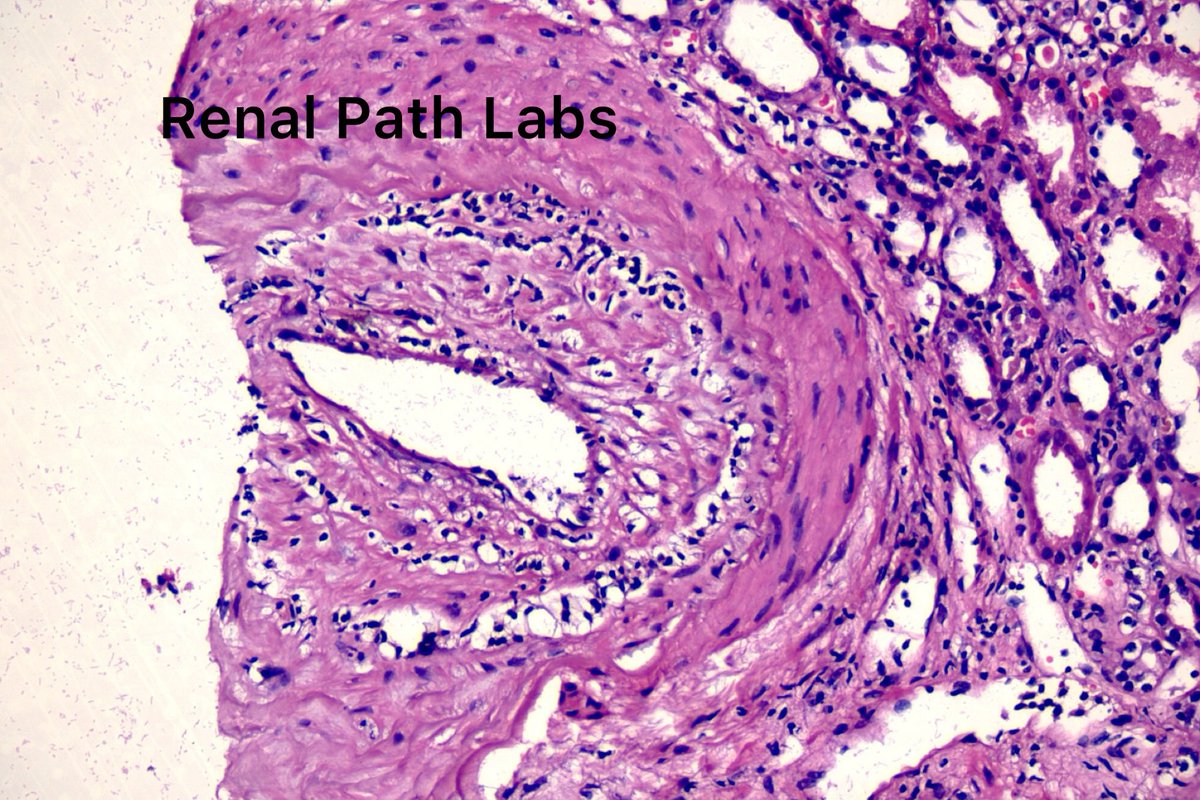 RenalPathLabs's tweet photo. For post graduates!
What do you see in these images? Different cases!
1,2: Native 3,4: Recent Transplant #RenalPath #PathTwitter #RenalPathology #Askrenal #AskrenalPath @RenalPathLabs #ISRTP #RenalPathologySociety https://t.co/E053u8iIgh