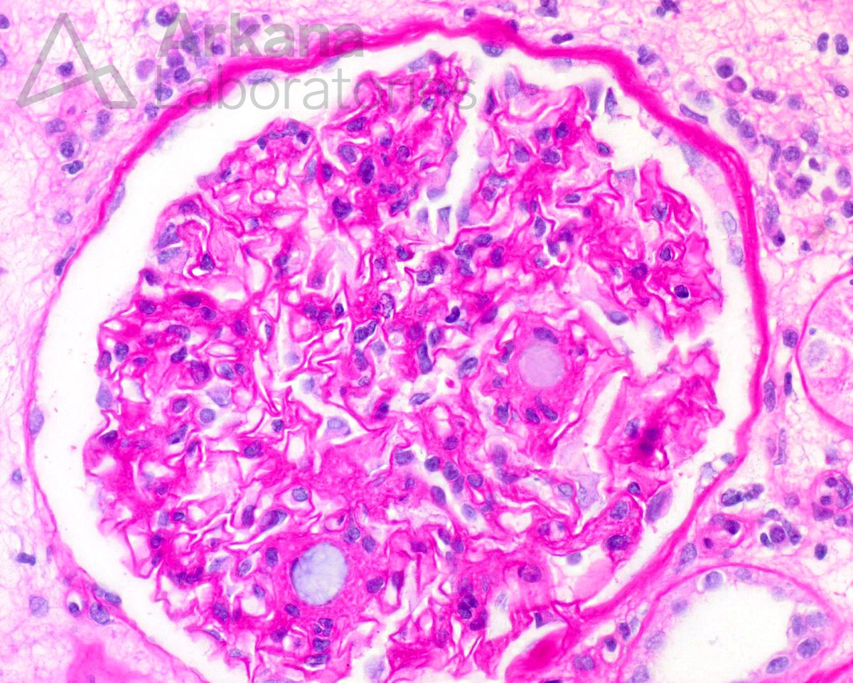 arkanalabs's tweet image. In a renal transplant recipient, what is your diagnosis?
#NephTwitter #renalpath