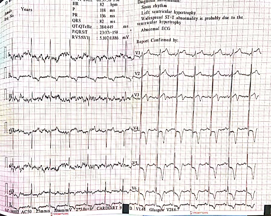 65 yrs male with two episodes of syncope . Hypertensive on treatment..on examination pansystolic murmur 3/5 at apex 🗝️ What to look for in echo ?? @DrRajeshG1 @ECGWeekly