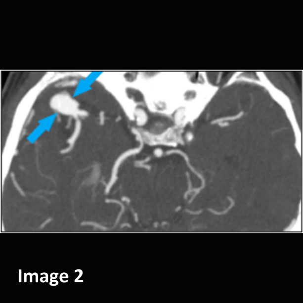vRad's tweet photo. Great call by a vRad #rad on a non-contrast #CT Head. In a patient w/ transient left facial numbness, Dr. S identified a mildly hyperdense focus in the right middle cranial fossa &amp; suggested possibility of a right middle cerebral artery (MCA) aneurysm.

#neuroradiology #cthead https://t.co/q9tXhDWEXo