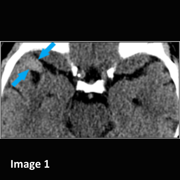 vRad's tweet photo. Great call by a vRad #rad on a non-contrast #CT Head. In a patient w/ transient left facial numbness, Dr. S identified a mildly hyperdense focus in the right middle cranial fossa &amp; suggested possibility of a right middle cerebral artery (MCA) aneurysm.

#neuroradiology #cthead https://t.co/q9tXhDWEXo