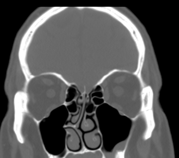 DrScottFortune's tweet photo. Have you seen a septal spur do this? #septalspur #deviatedseptum #sinusctscan #rhinology https://t.co/jFp40kaQnv