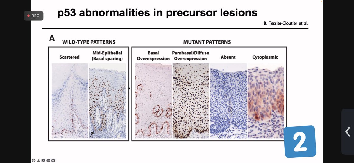 Janira Navarro (@janiranavarro) on Twitter photo Vulva-precursor lesions <a href="/ISGynP/">International Society of Gynecologic Pathologists</a>
1️⃣Vulvar squamous intraepitelial neoplasia classification by <a href="/CPHpath/">Carlos Parra-Herran MD</a>
-HPV associated VIN
-HPV indep p53 mutant
-HPV indep p53 wild type
2️⃣p53 expression patterns VIN #everydayGYN #Gynpath #pathology #PathResident #pathfellow #PathTwitter Vulva-precursor lesions <a href="/ISGynP/">International Society of Gynecologic Pathologists</a>
1️⃣Vulvar squamous intraepitelial neoplasia classification by <a href="/CPHpath/">Carlos Parra-Herran MD</a>
-HPV associated VIN
-HPV indep p53 mutant
-HPV indep p53 wild type
2️⃣p53 expression patterns VIN #everydayGYN #Gynpath #pathology #PathResident #pathfellow #PathTwitter