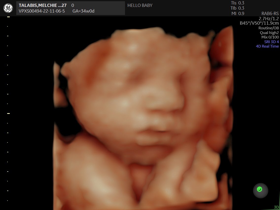 MelchTalabis28's tweet photo. I can’t wait to meet you and hold you in my arms, my BabyLove .. Iloveyouuuusomuch.. #TeamDecember #MyRainbowBabyGirl 🥰❤️😇🌈🤰🏼 https://t.co/uJUqHB4pIy