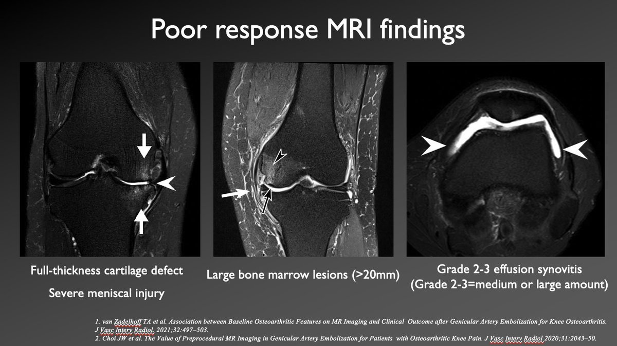 MRI findings poor response to GAE

In my opinion, full-thickness cartilage defect is the strongest association with less pain reduction.

pubmed.ncbi.nlm.nih.gov/33132027/
pubmed.ncbi.nlm.nih.gov/33526342/

#Irad