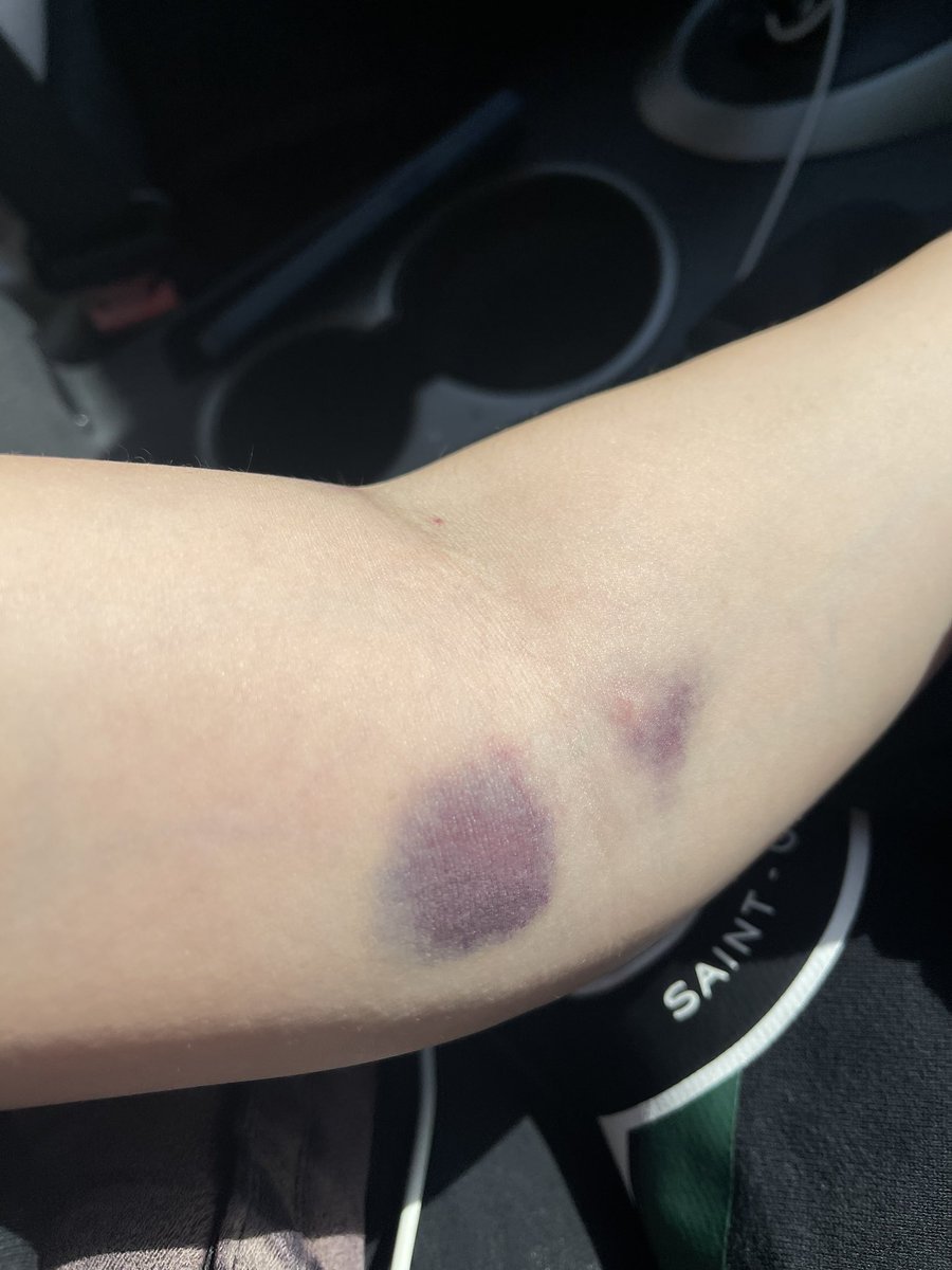 xoxforeign's tweet image. DO NOT GO TO @MedStarHealth IN OLNEY. MEDSTAR MONTGOMERY HAS THE WORST PATIENT CARE. NURSES TALK SHIT ABOUT THEIR PATIENTS. INSTEAD OF HELPING A FULL ER, YOUR NURSES ARE FLIRTING WITH SECURITY GUARDS OUTSIDE. PT1