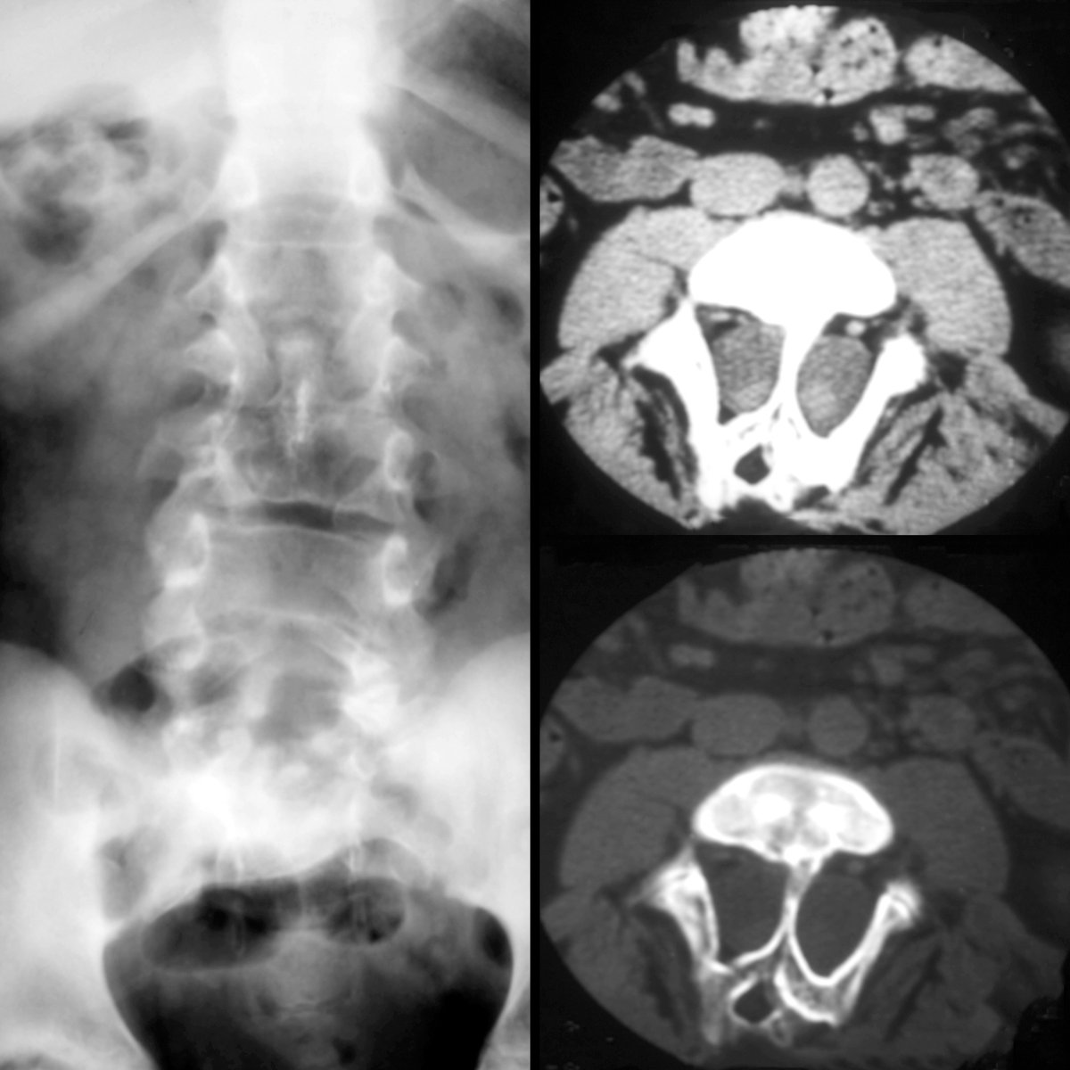 pedsimaging's tweet photo. School ager with skin stigmata along spine

Radiograph suggests linear piece of bone in center of spinal canal at L2-L3 level. CT at L2-L3 shows spinal cord+thecal sac bisected by boney bridge in center of spinal canal. There is also evidence of vertical fusion of spinal lamina https://t.co/jq1fuKPyZJ