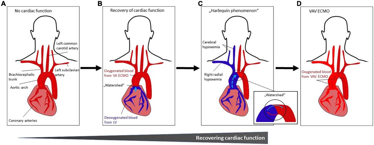 ❤️‍🩹We report clinical and physiological insights of a patient with STEMI further complicated by refractory OHCA and differential hypoxemia. MCS with VA-ECMO➡️Impella➡️VAV-ECMO. ❤️‍🩹

frontiersin.org/articles/10.33…

<a href="/ELSOOrg/">ELSO</a> <a href="/ERC_resus/">ERC - European Resuscitation Council</a> @erc_young