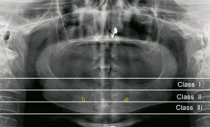 OviDentalGo's tweet photo. ► Classification of bone resorption
* Class I: Mild resorption—loss of one-third of
vertical ridge height.
* Class II: Moderate resorption—loss of one-third to
two-third of vertical height.
* Class III: Severe resorption—greater than two-third
loss
#boneresorption #Ovidental https://t.co/3nyPPbDrox