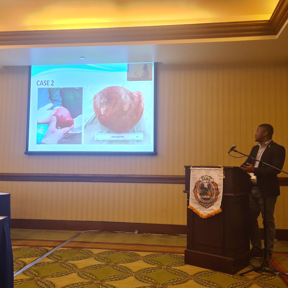Satyendra Persaud MBBS DM (Urol) FRCS FACS FFSTEd (@persauddr) on Twitter photo Dr Jamal Pyle and <a href="/rcsukhraj/">Rajendra Sukhraj</a> presenting their series on giant bladder stones, a problem we continue to encounter in the developing world when the nearest medical care may be miles away! #CURA2022 Dr Jamal Pyle and <a href="/rcsukhraj/">Rajendra Sukhraj</a> presenting their series on giant bladder stones, a problem we continue to encounter in the developing world when the nearest medical care may be miles away! #CURA2022