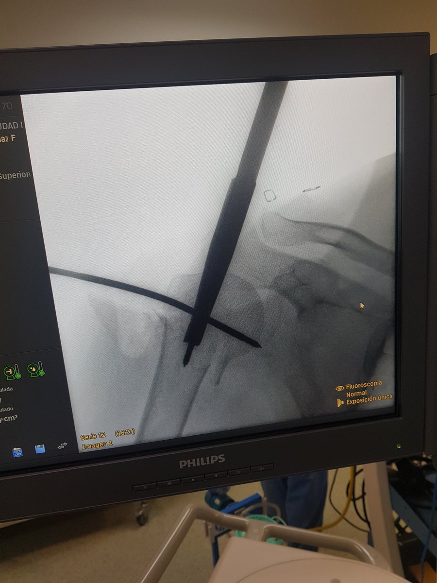 AlbertoLopezAr1's tweet photo. Fractura de humero proximal ( cuello quirúrgico desplazada en varo). Secuencia de escopia en quirofano:
- reduccion indirecta con steinman
- enclavado endomedular corto
-resultado final https://t.co/ARVIez8c21