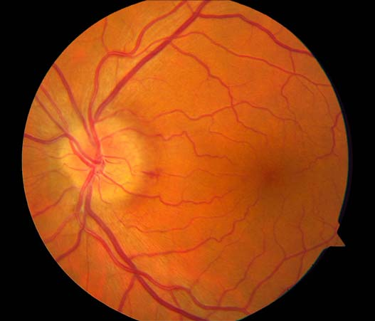 jcpastorj's tweet photo. #IOBA_UVa Seguimos incluyendo pacientes con neuropatías ópticas isquémicas no-arteríticas de menos de 15 días de evolución, para tratarlas con células madre alogénicas intravitreas. Es un multicéntrico. Posibles candidatos, contactar con 696 918293 o neurostem@ioba.med.uva.es https://t.co/7FcyK0bh7v