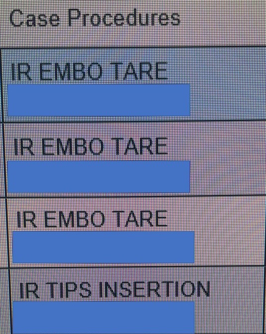 Zach Berman MD (@ztberman) on Twitter photo Busy day taking care of our chronic liver disease patients at <a href="/ucsd_ir/">UC San Diego Interventional Radiology</a>. #TARE for HCC x3 and #TIPS + embo for variceal bleeding. <a href="/Ajairam_MD_IR/">Abhi Jairam</a> , our PGY-4 IR/DR resident rocked it as first assist on all the cases. <a href="/UCSDRadRes/">UCSDRadRes</a> <a href="/SeanTutton/">Sean Tutton</a> #Theraspheres <a href="/WLGoreMedical/">WLGoreMedical</a> Busy day taking care of our chronic liver disease patients at <a href="/ucsd_ir/">UC San Diego Interventional Radiology</a>. #TARE for HCC x3 and #TIPS + embo for variceal bleeding. <a href="/Ajairam_MD_IR/">Abhi Jairam</a> , our PGY-4 IR/DR resident rocked it as first assist on all the cases. <a href="/UCSDRadRes/">UCSDRadRes</a> <a href="/SeanTutton/">Sean Tutton</a> #Theraspheres <a href="/WLGoreMedical/">WLGoreMedical</a>