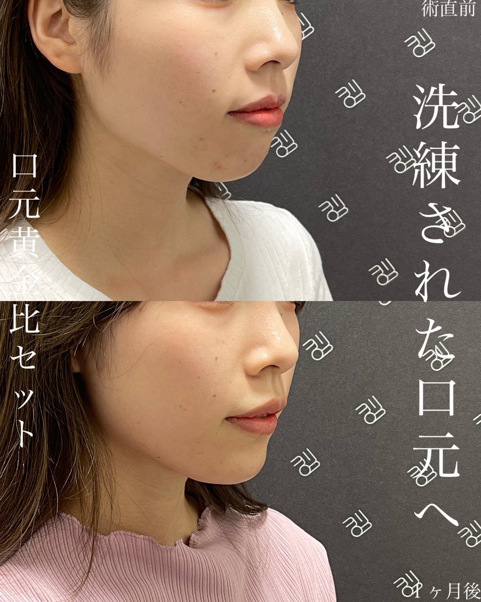 tenyuru's tweet photo. “フォローワー1万人”を記念して
100万円相当の施術をプレゼント‼︎

特別モニターを“4名様”募集します

【キャンペーン内容】
1等 プレミアム黄金比セット1名様
(40万円相当)
➡︎1万円(税込、麻酔代込)

2等 口元黄金比セット3名様
(18万円相当)
➡︎1万円(税込、麻酔代込)

続く➡︎ https://t.co/Gl405xGQhL