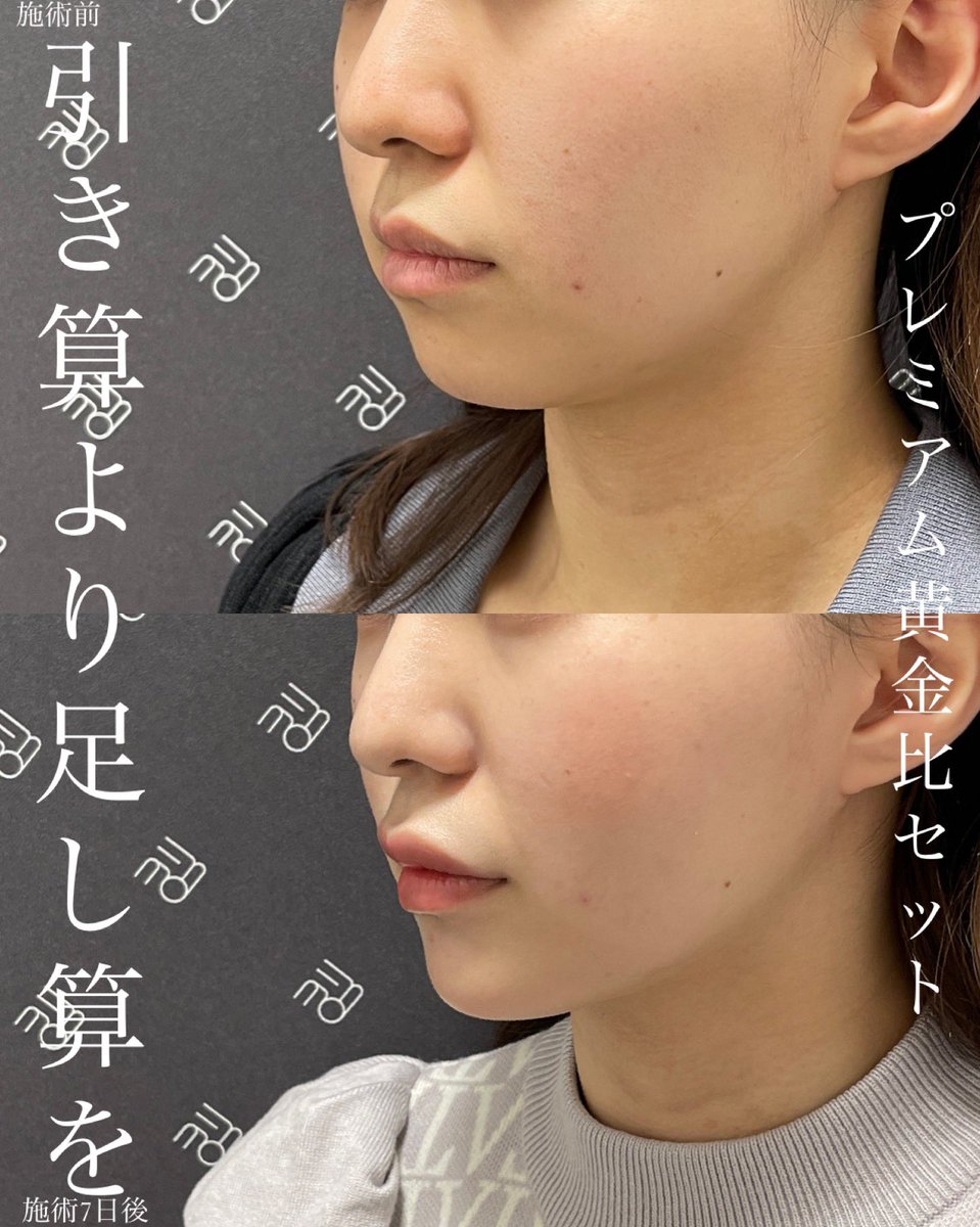 tenyuru's tweet photo. “フォローワー1万人”を記念して
100万円相当の施術をプレゼント‼︎

特別モニターを“4名様”募集します

【キャンペーン内容】
1等 プレミアム黄金比セット1名様
(40万円相当)
➡︎1万円(税込、麻酔代込)

2等 口元黄金比セット3名様
(18万円相当)
➡︎1万円(税込、麻酔代込)

続く➡︎ https://t.co/Gl405xGQhL