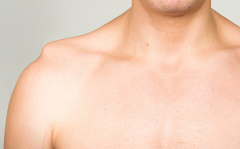 drdozellodc's tweet photo. Shoulder Separation AKA Acromioclavicular Joint (AC Jt) Dysfunction
Dr Donald Ozello DC
#chiropractor #chiropractic #sportsmedicine #shoulder #shoulderpain #shoulderseparation #acjoint #acjt #acromioclavicular #acromioclavicularjoint #shoulderdysfunction https://t.co/lUNoOgH3A7 https://t.co/dAYmhhubyw