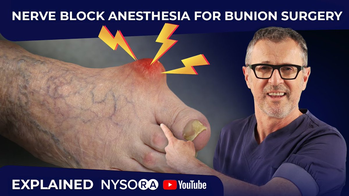 NYSORA's tweet photo. You don’t need a full #AnkleBlock for #bunionectomy. In our newest Youtube video, Dr Hadzic will be showing you the specific tricks on how to use an ankle block for painless #bunion surgery. Check here: https://t.co/PXEqjiu6FE

#regionalanesthesia #nysora https://t.co/aULHTcIRdB