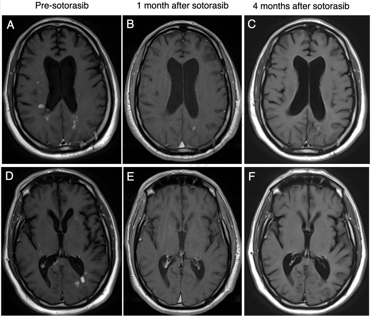 Chul Kim (@chulkimmd) on Twitter photo Our case report is out #JTOCRR <a href="/JTOonline/">JTO & JTO CRR</a>!
Here we describe a patient with KRAS G12C-mutated lung adenocarcinoma and untreated brain metastases who achieved significant clinical and radiographical response to #sotorasib.
bit.ly/3DKnuSy Our case report is out #JTOCRR <a href="/JTOonline/">JTO & JTO CRR</a>!
Here we describe a patient with KRAS G12C-mutated lung adenocarcinoma and untreated brain metastases who achieved significant clinical and radiographical response to #sotorasib.
bit.ly/3DKnuSy
