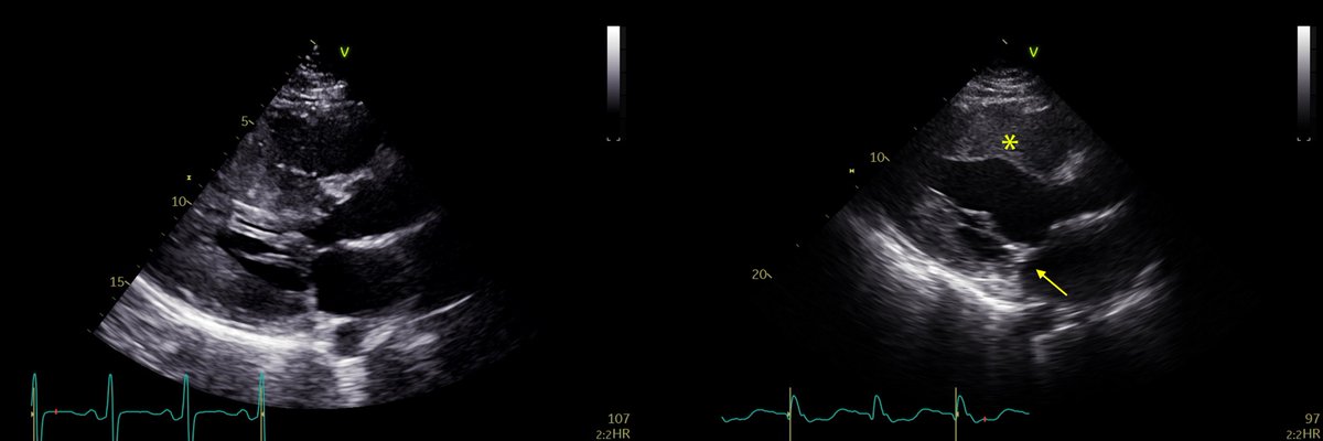 RCMjournal's tweet photo. #RCM - Vol. 22 No. 3
#Callforread
💫Original Research - Echocardiographic and clinical outcomes of patients undergoing septal myectomy plus anterior mitral leaflet extension for hypertrophic cardiomyopathy
@SarahAC_
#HCM #mitralvalve #LVOT
Full text:
https://t.co/CWvYeqF1fL https://t.co/ReeJwc4JfA