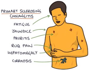 Biliary cholangitis is a chronic disease in which the bile ducts in your liver are slowly destroyed. There's no cure for primary biliary cholangitis, but medications are available to prevent complications.
#biliarycholangitis #chroncdisease #bileductdestroys #endocrinology